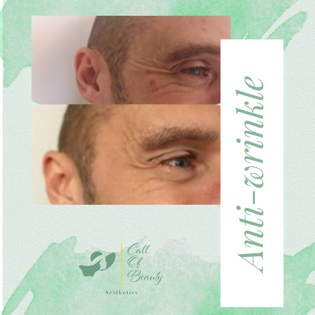 Crows Feet Anti Wrinkle Treatment