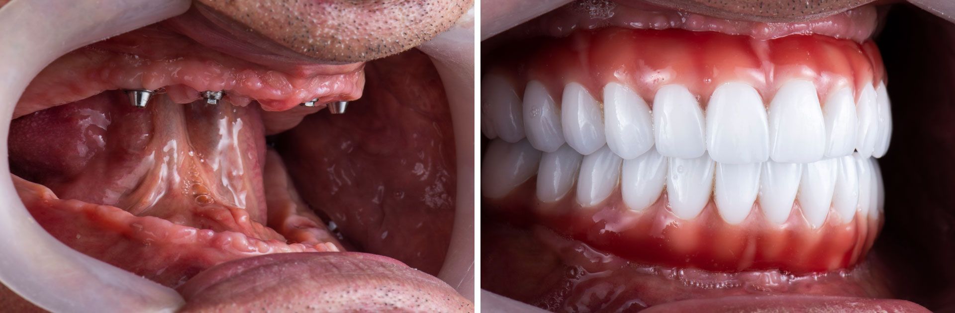 An image of a patient's teeth before and after dental implants