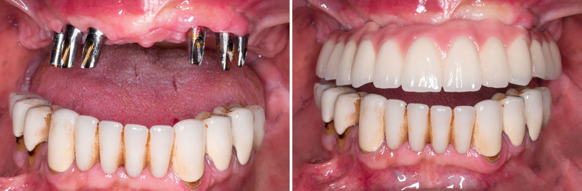 An image of a patient's teeth before and after dental implants