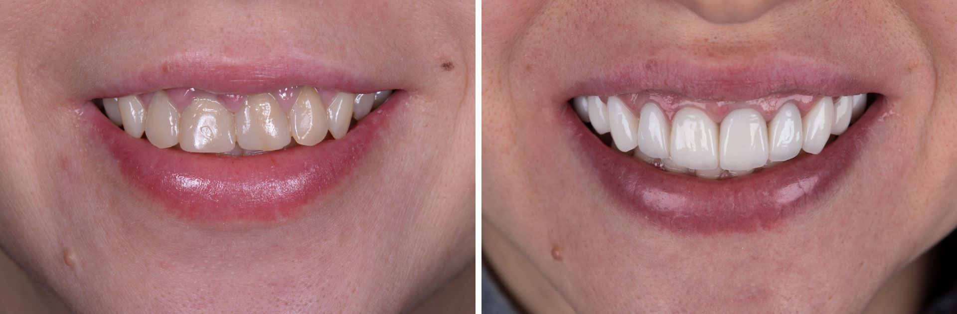 An image of a patient's teeth before and after veneers