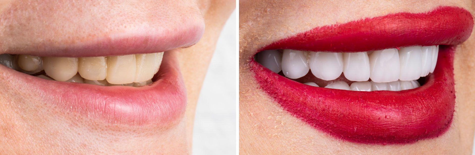 An image of a patient's teeth before and after veneers