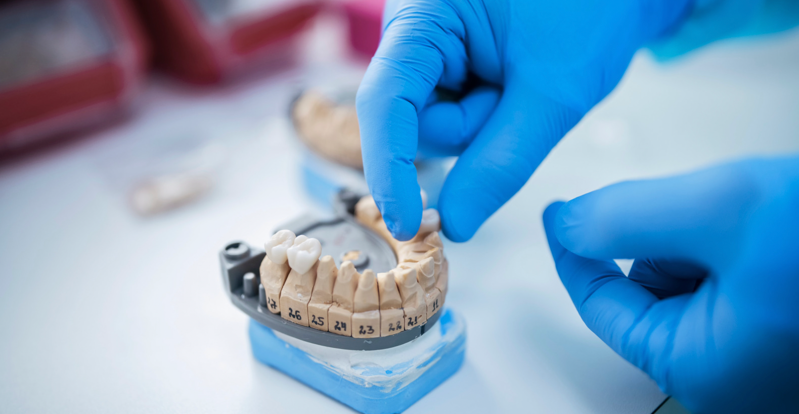 Bridges vs. Implants: Which Tooth Replacement Option Is Right for You?