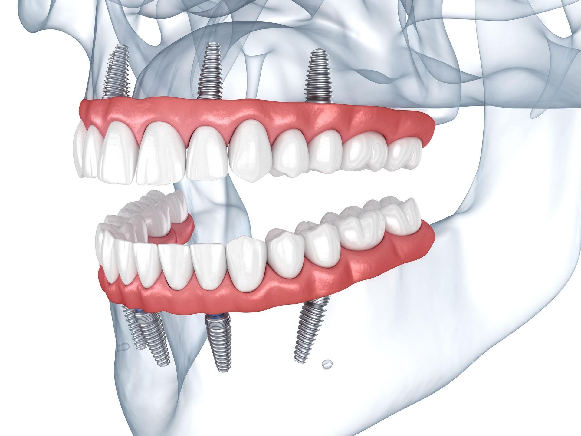 A computer generated image of a mouth reconstructed with upper and lower implants