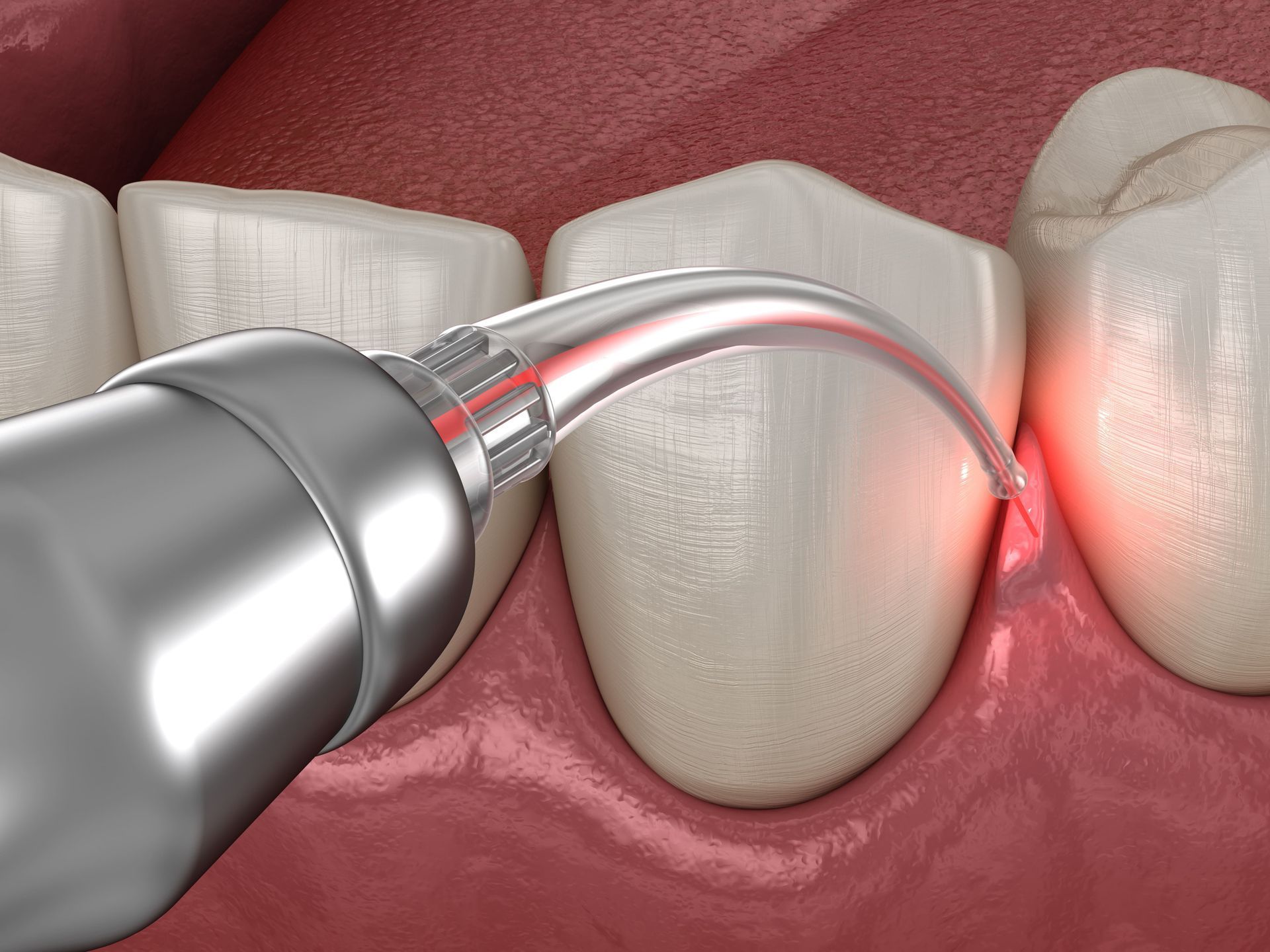 A computer generated image of a tooth and gums being treated by a laser