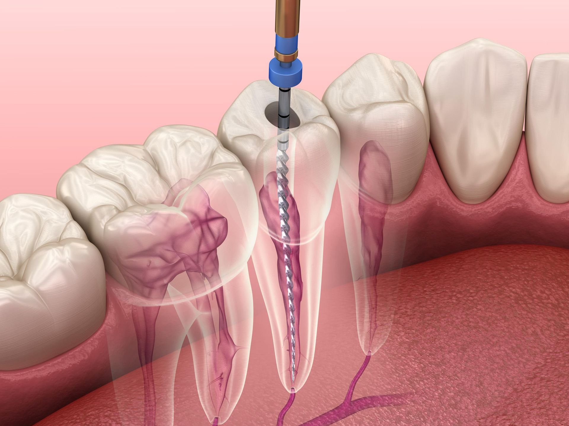 A computer generated image of a tooth root being cleaned with an instrument