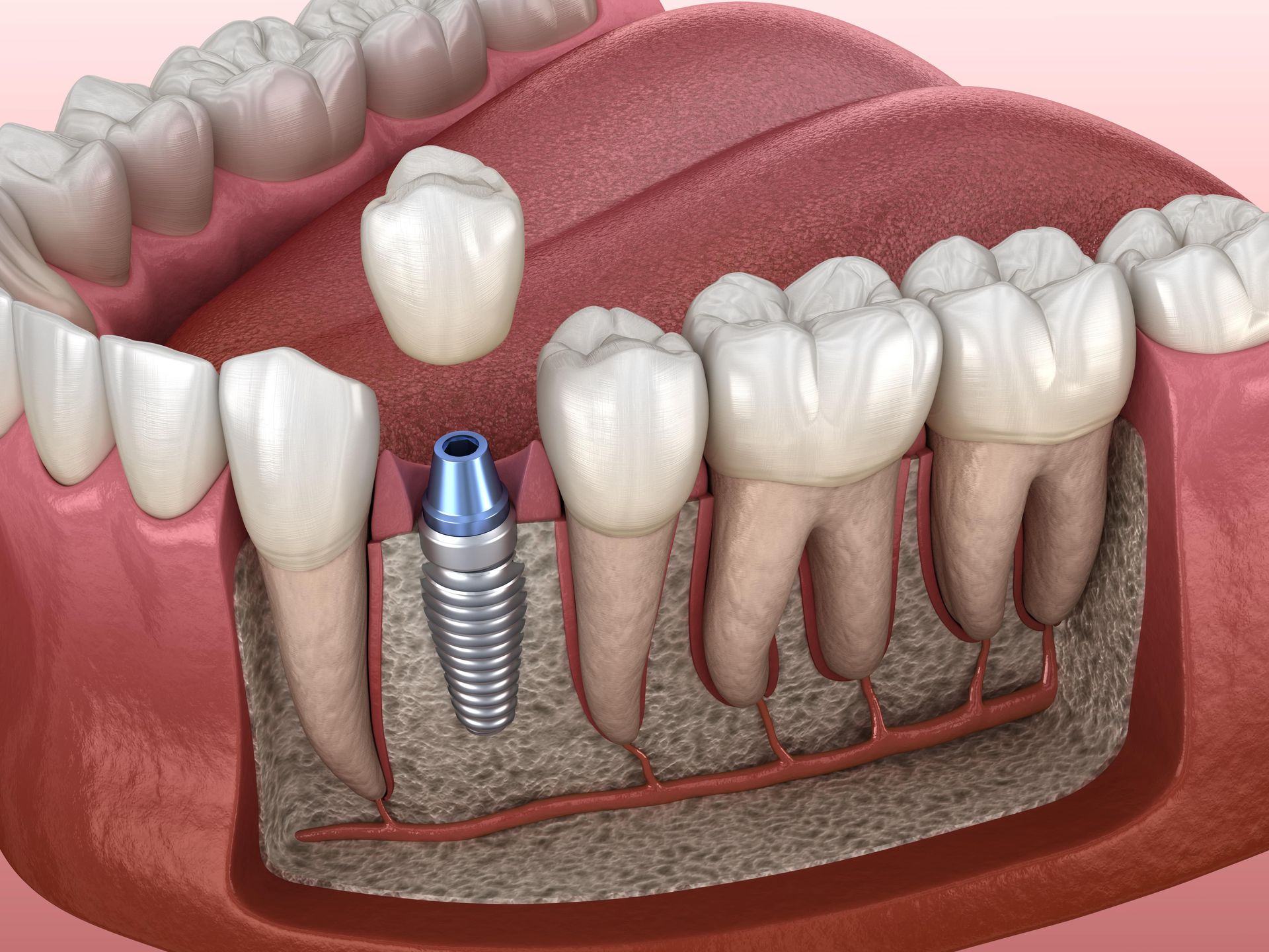 A computer generated image of the inside of the gum showing the dental implant