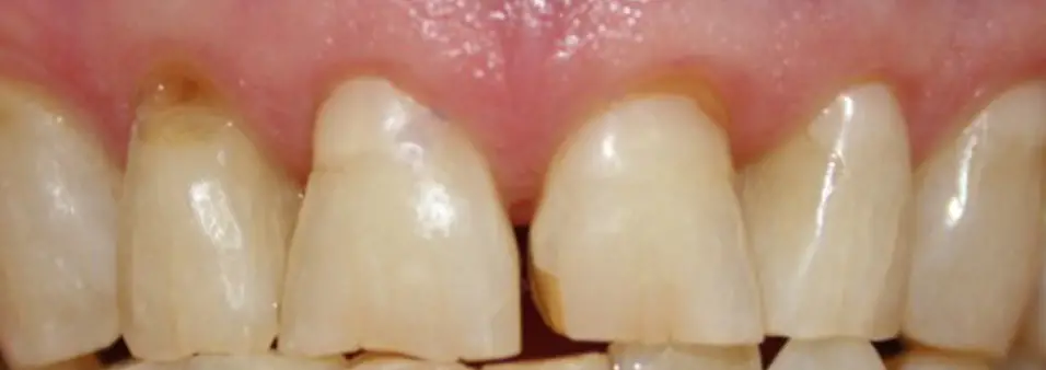 before dental bonding patient three