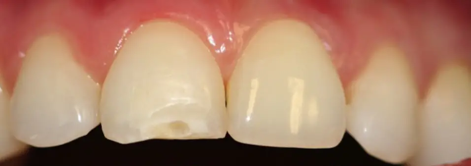 before dental bonding patient one