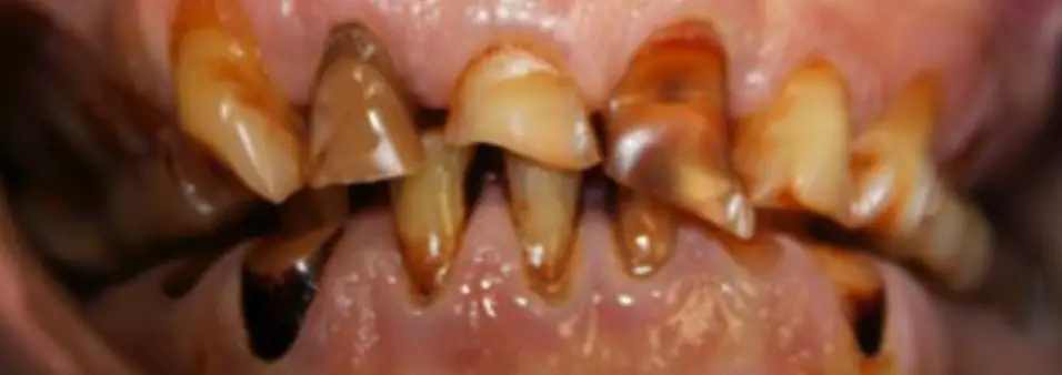 before  dental bonding patient two