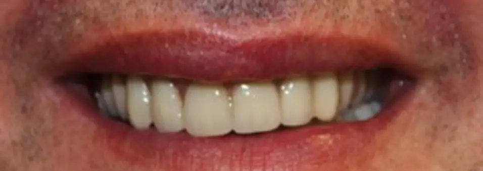 after dental implants