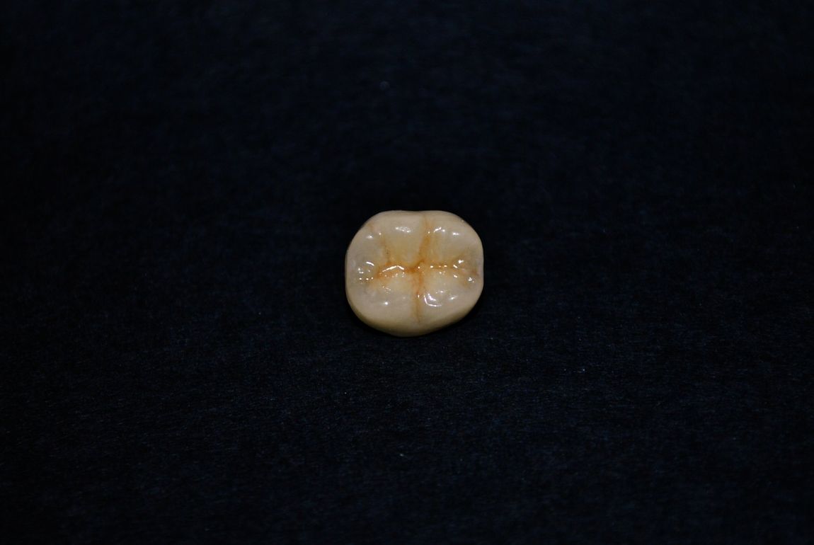 protesi dentale in disilicato di litio