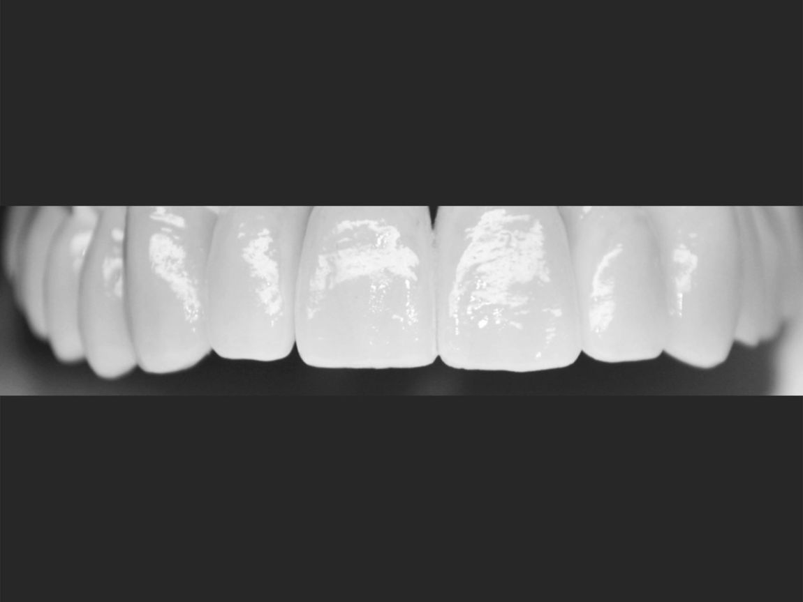 protesi dentali in cromocobalto