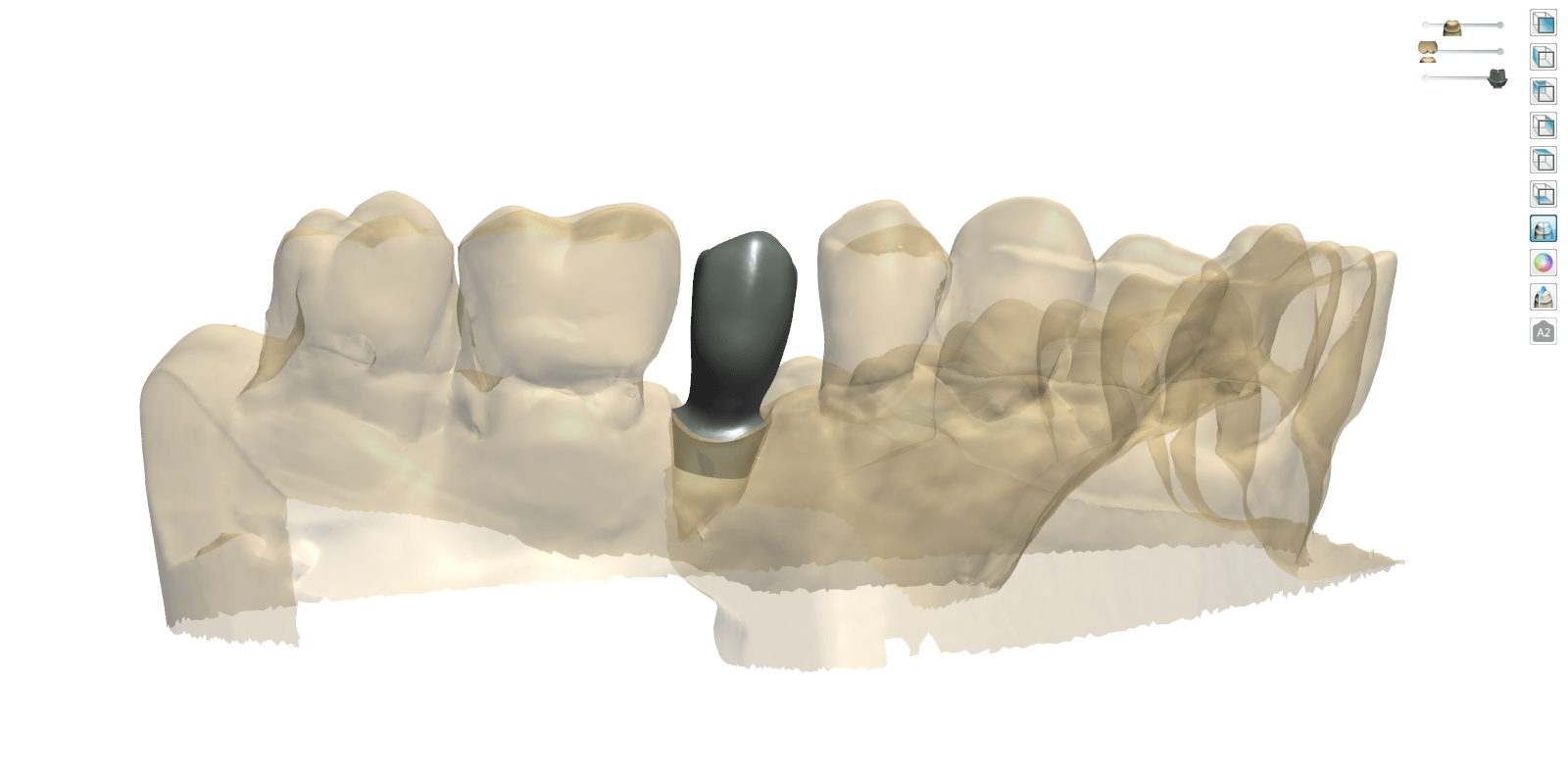 Protesi dentali in Titanio