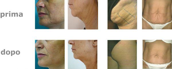 effetti massaggi con radiofrequenza