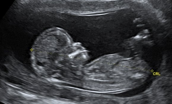 Ultrasonido, para qué sirve un ultrasonido, atención prenatal, biopsias