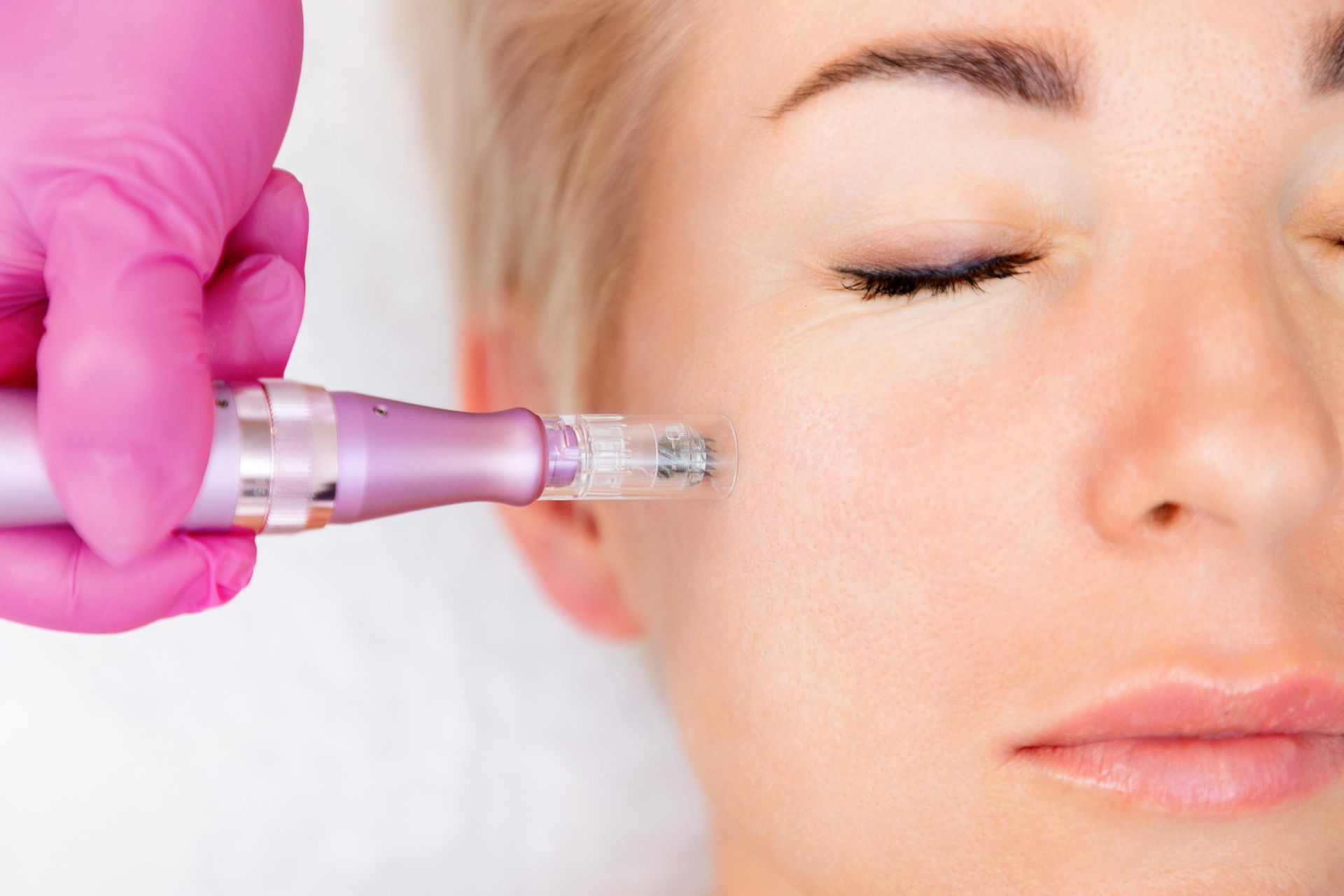 A woman is getting a microneedle treatment on her face.