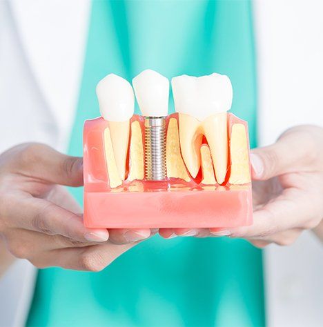 Dental Implant Illustration — Pinole, CA — Dalia E. Perez-Salinas, D.D.S.