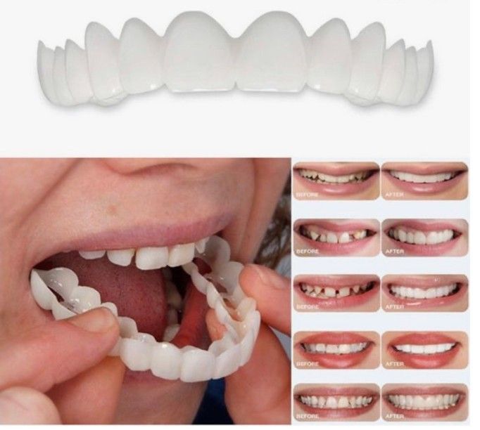 before & after of multiple snap on veneers in collage