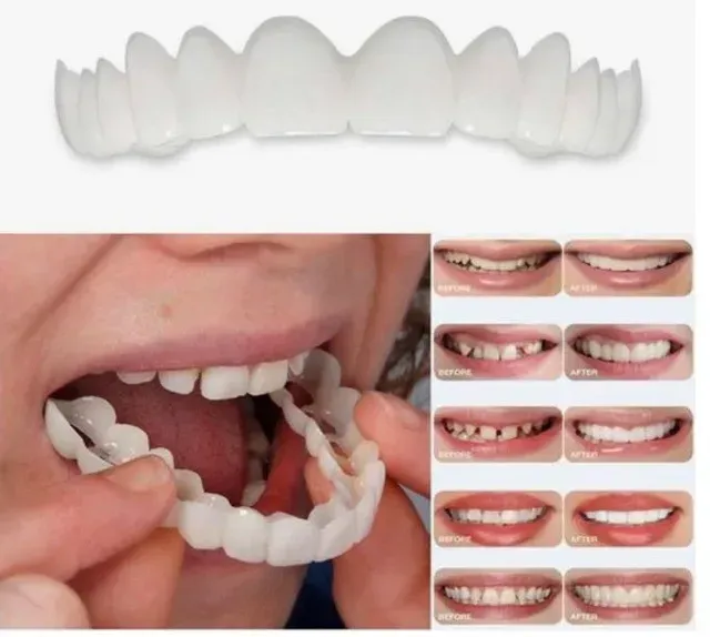 snap on veneers