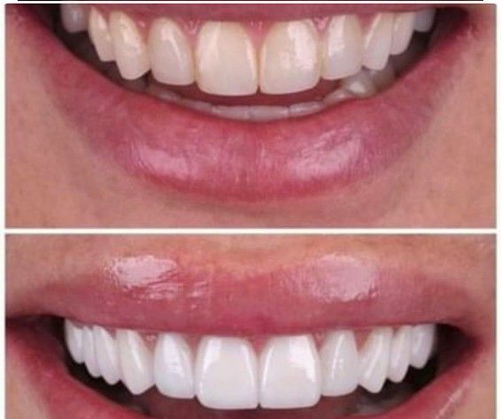 before & after snap on veneer