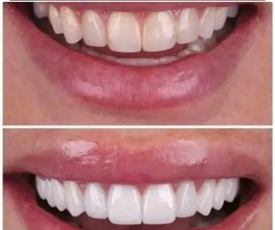 before & after of sea on veneers