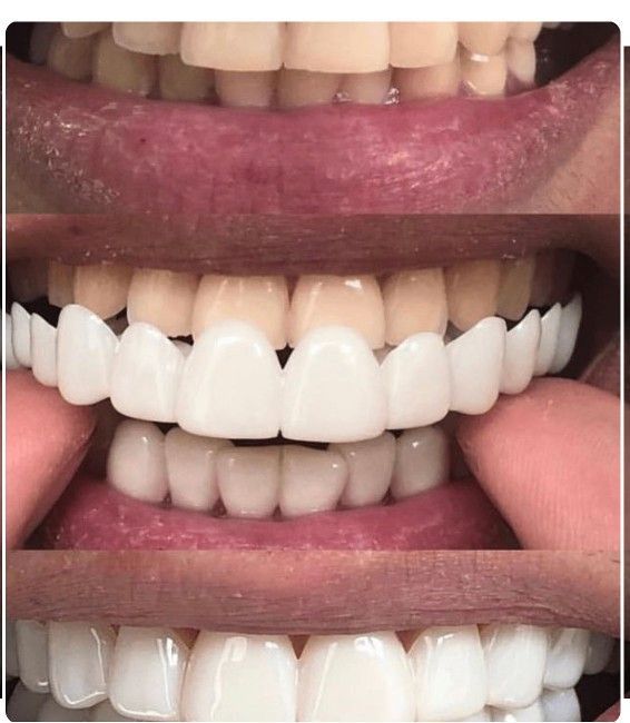 snap on veneer
