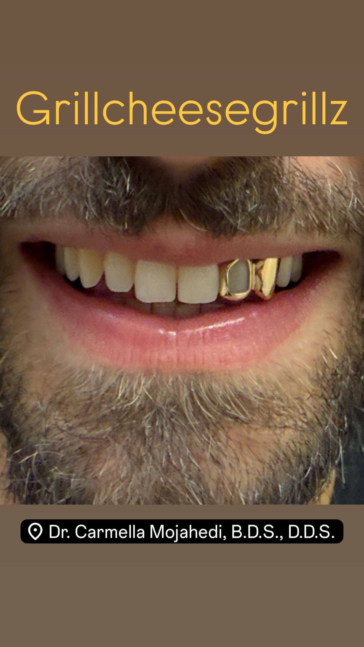 gold tooth caps