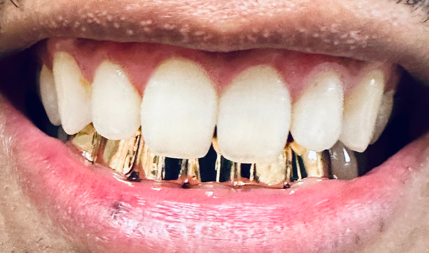 Gold bottom grill 