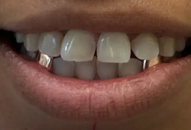 silver tooth caps