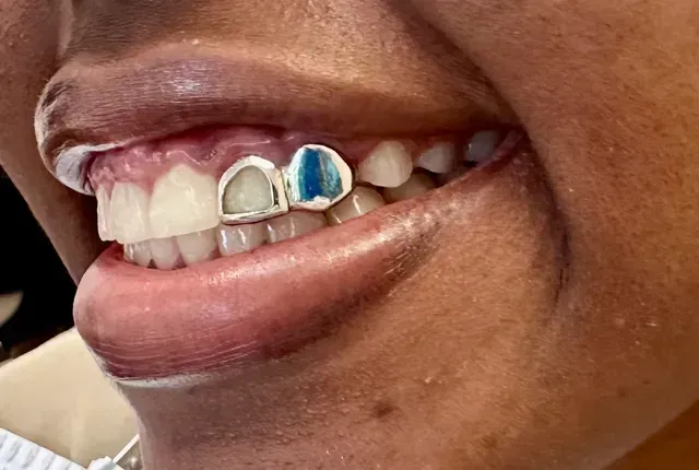 silver tooth cap and gem