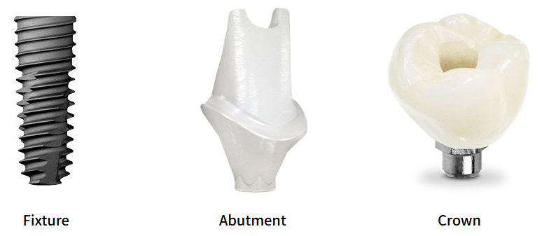 A picture of a fixture , abutment , and crown.