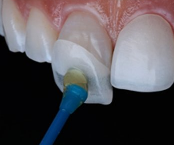 Close-up of a dental veneer being applied with a small blue-tipped applicator to a tooth.