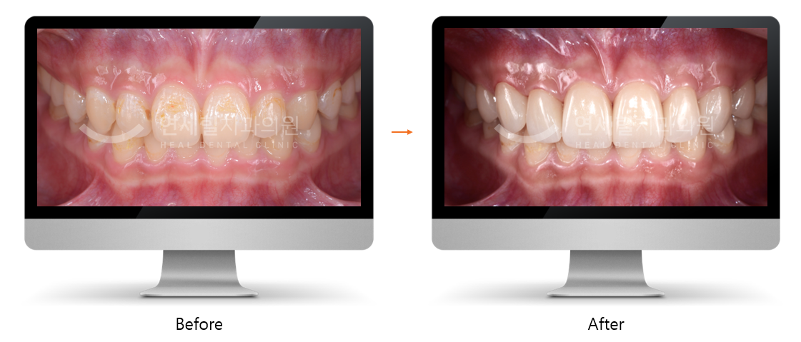 Teeth before and after cosmetic dental work: discolored, chipped teeth become bright and aligned.