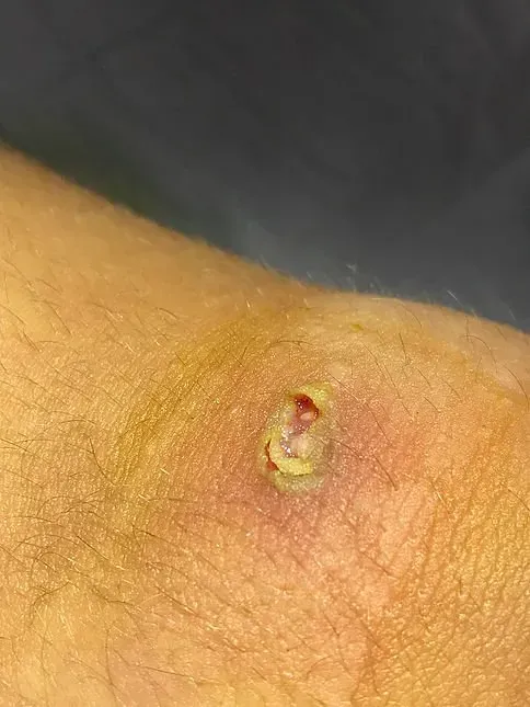 School Sores (Impetigo)