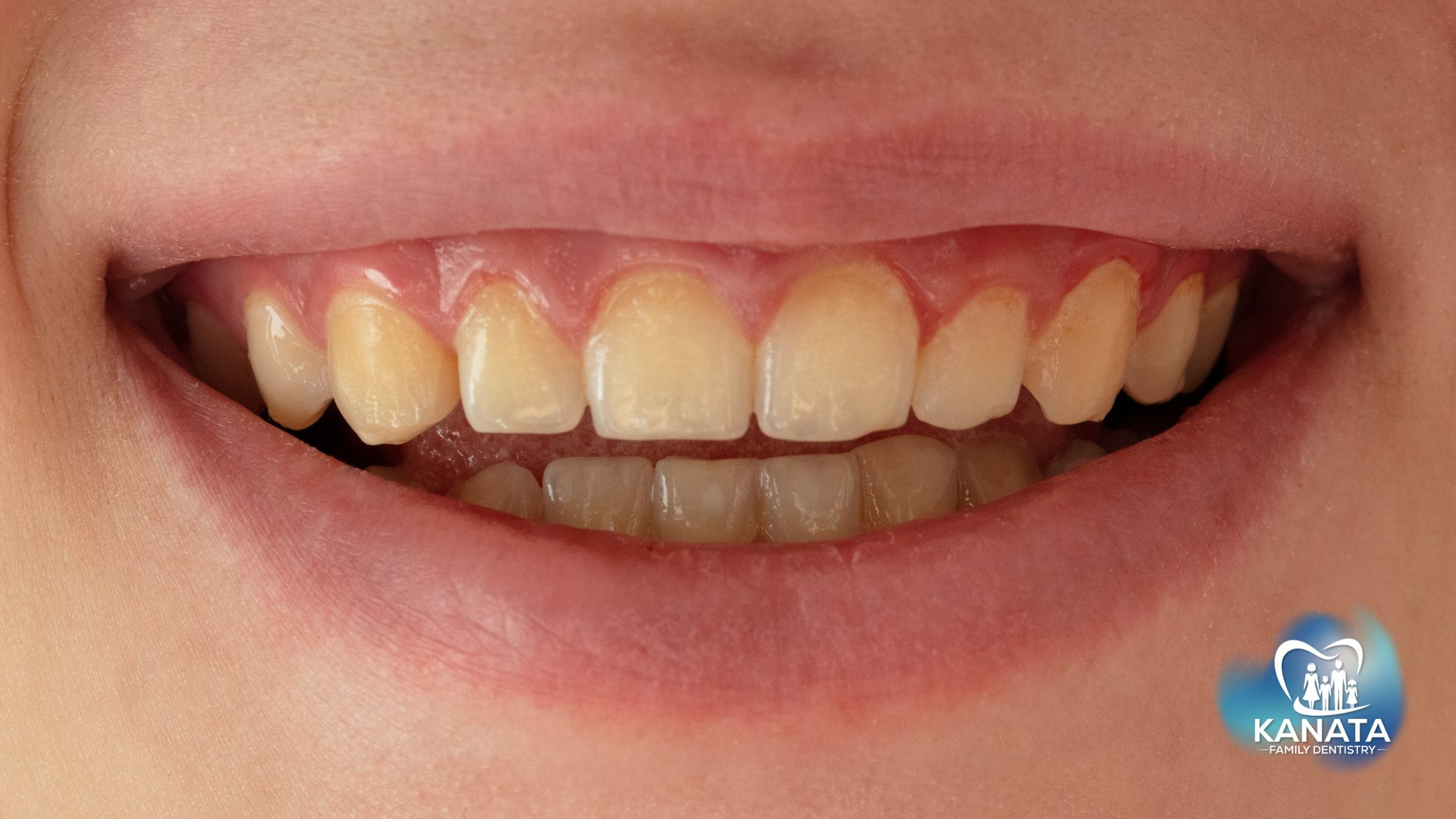A close up of a person 's teeth with a smile on their face.