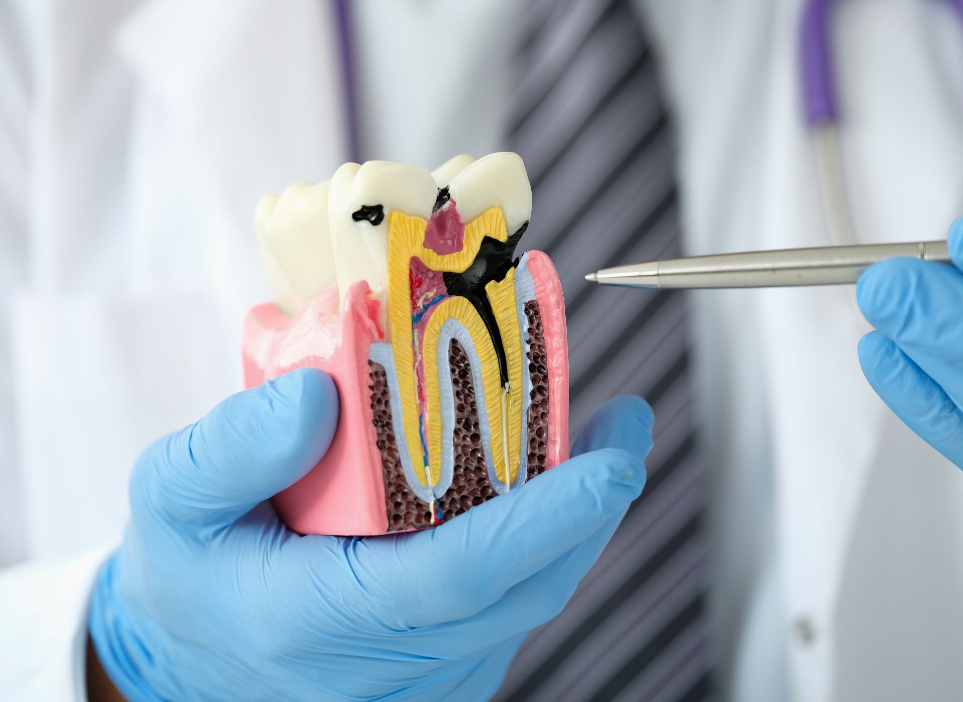 Dentist in blue gloves holds model tooth, pointing to decay; stethoscope in background.
