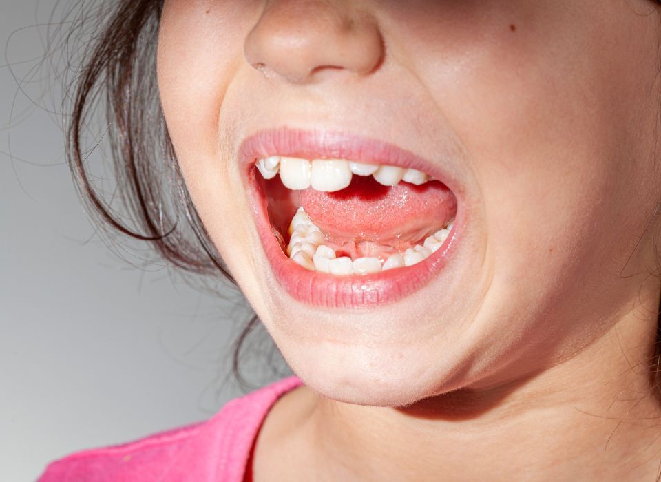 Child with open mouth showing missing tooth.