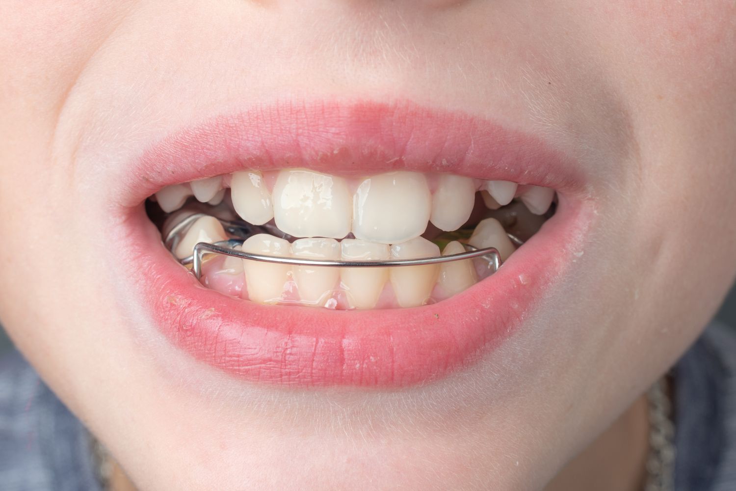Close-up of a person's mouth with a metal dental retainer in place over the lower teeth.