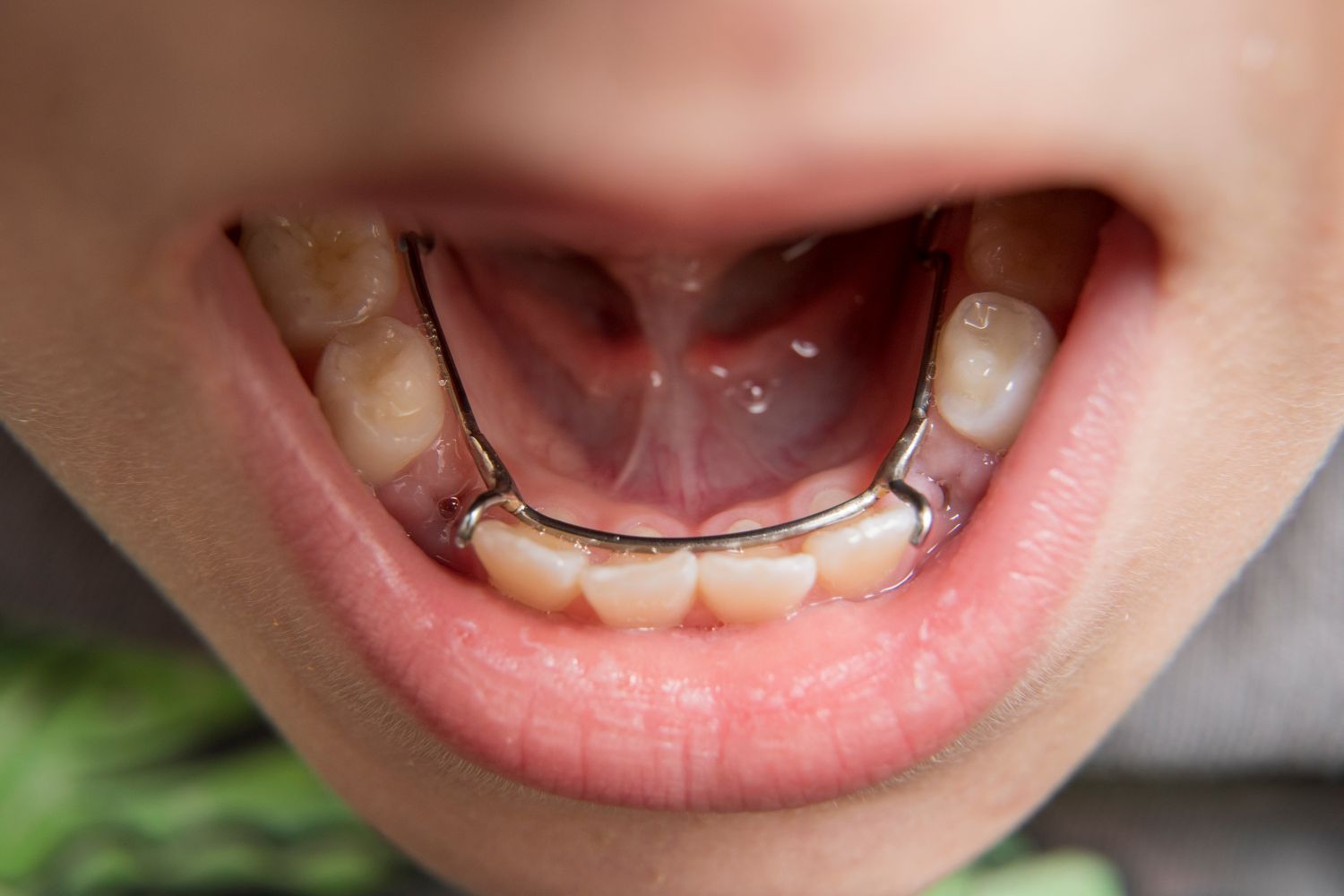 A dental appliance, a space maintainer, is fitted on a tooth to hold open space.
