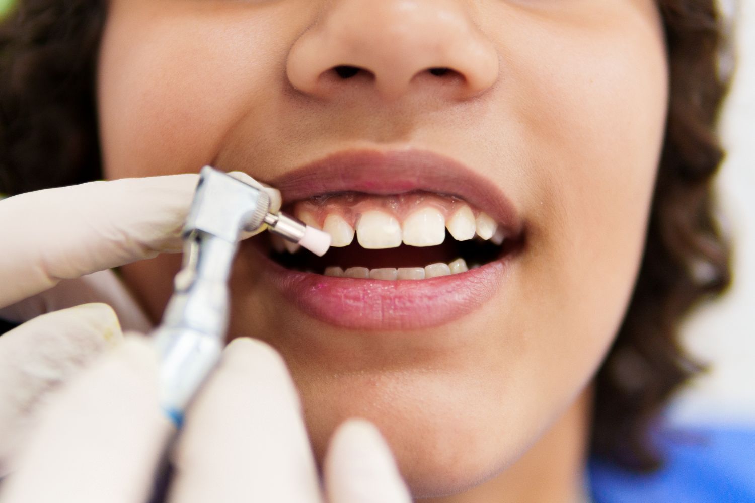 Person having their teeth polished at the dentist's office with a polishing tool.