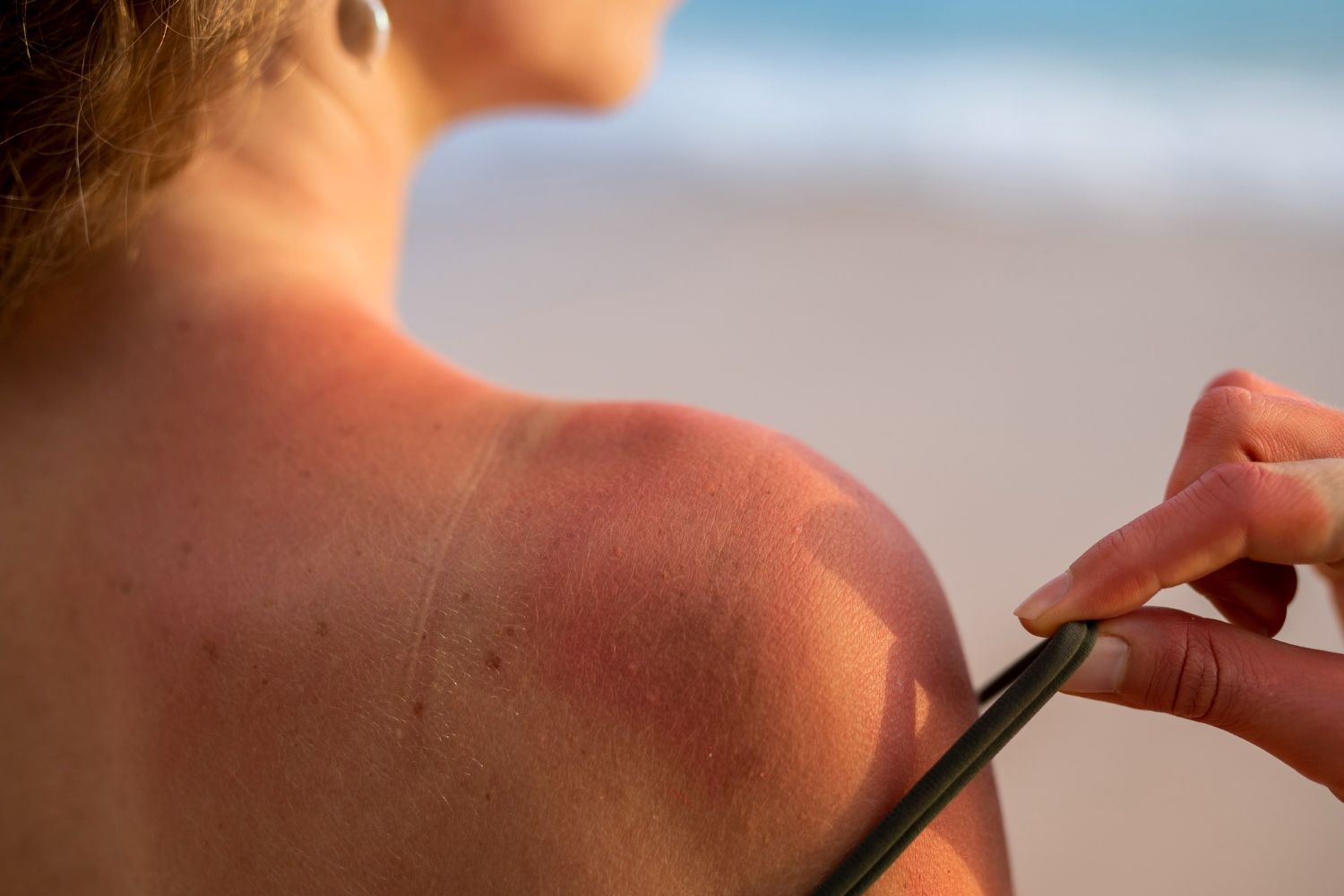 A woman is applying sunscreen to her sunburned shoulder on the beach.