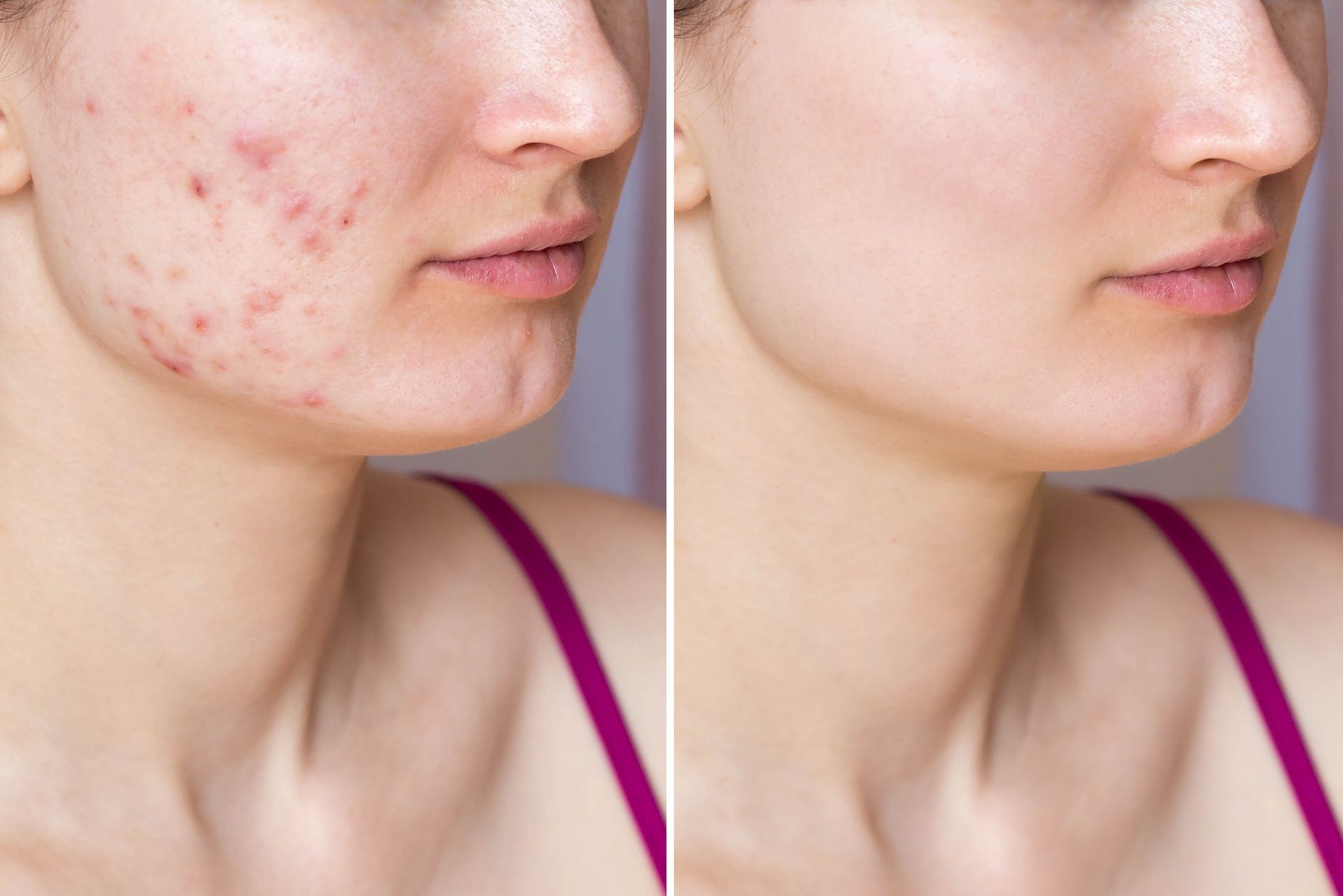 Side-by-side comparison: woman's face with acne, then with clear skin; shows before and after skincare.
