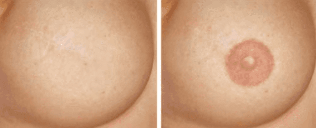 nipple repigmentation