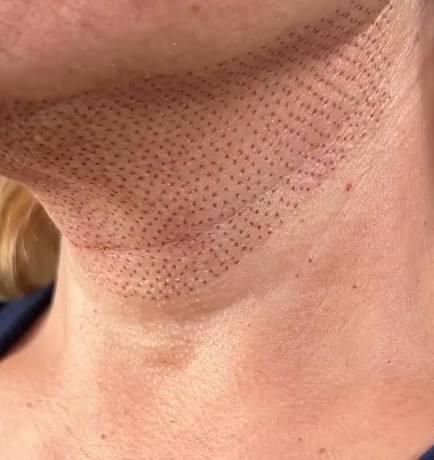 Cuello con patrón en forma de cuadrícula de pequeños puntos, probablemente posterior al procedimiento, en la piel.