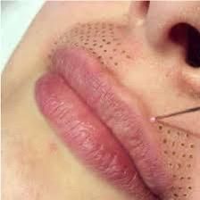 Labios inyectados con relleno, rodeados de puntos que indican el área de tratamiento.
