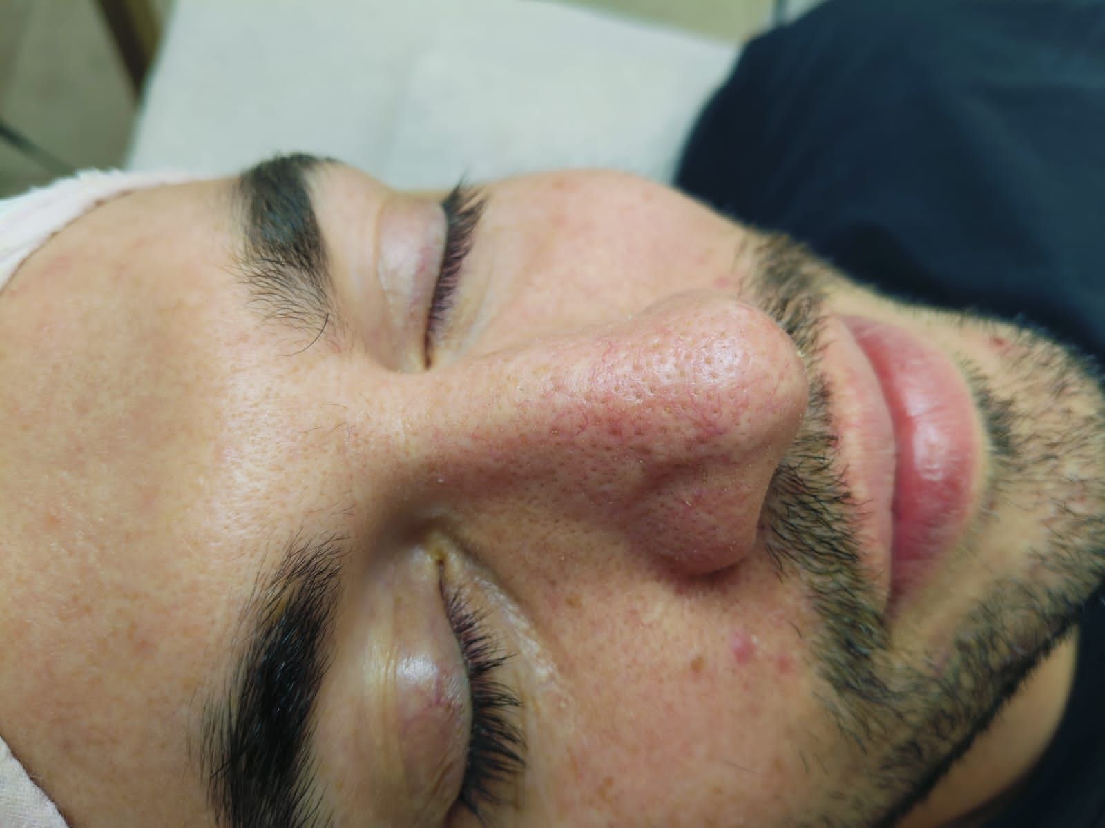Vista de perfil antes y después del rostro de una mujer, que muestra los efectos de una remodelación de nariz no quirúrgica.