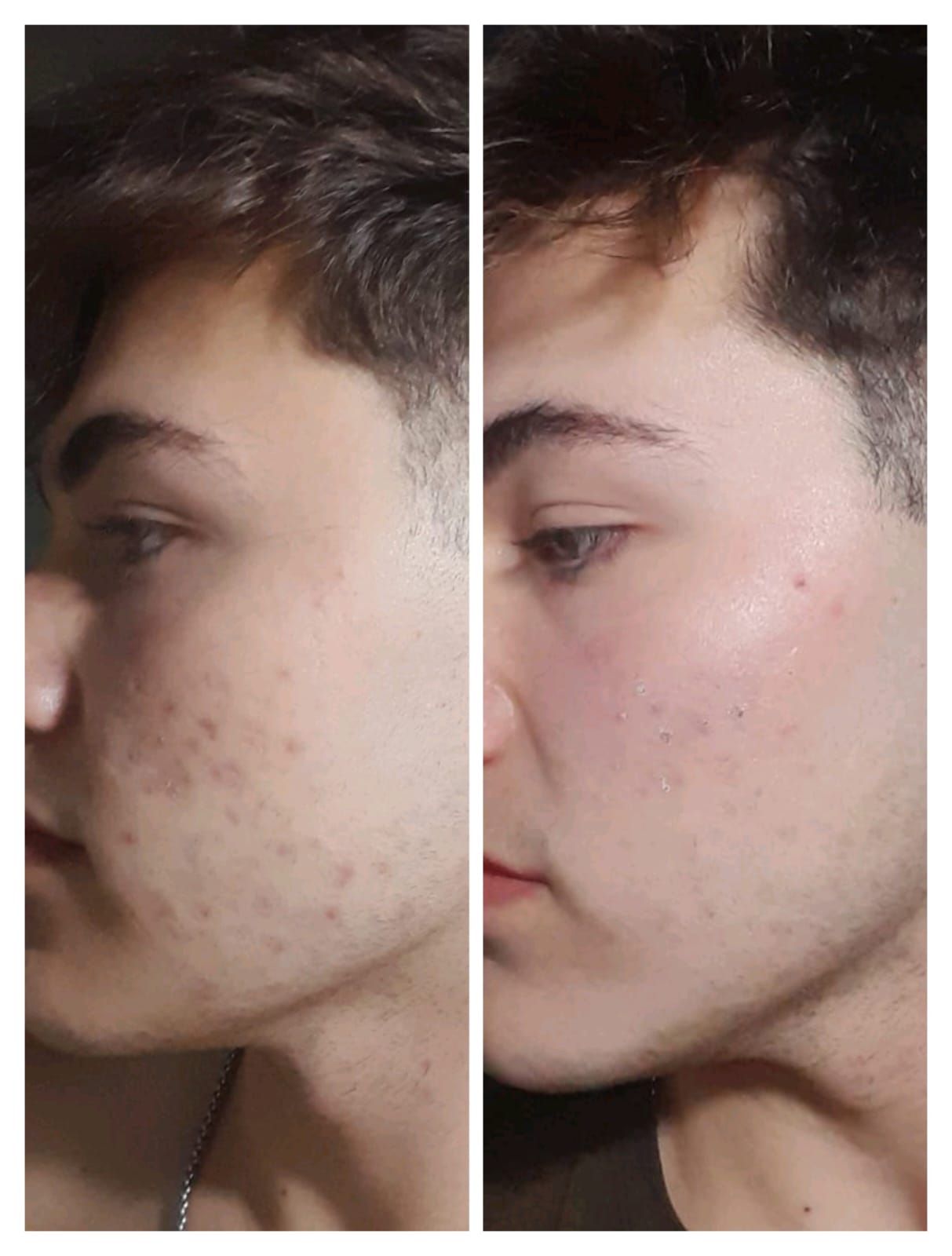 Comparación del rostro de una persona. A la izquierda se muestra el acné; a la derecha, la piel limpia.