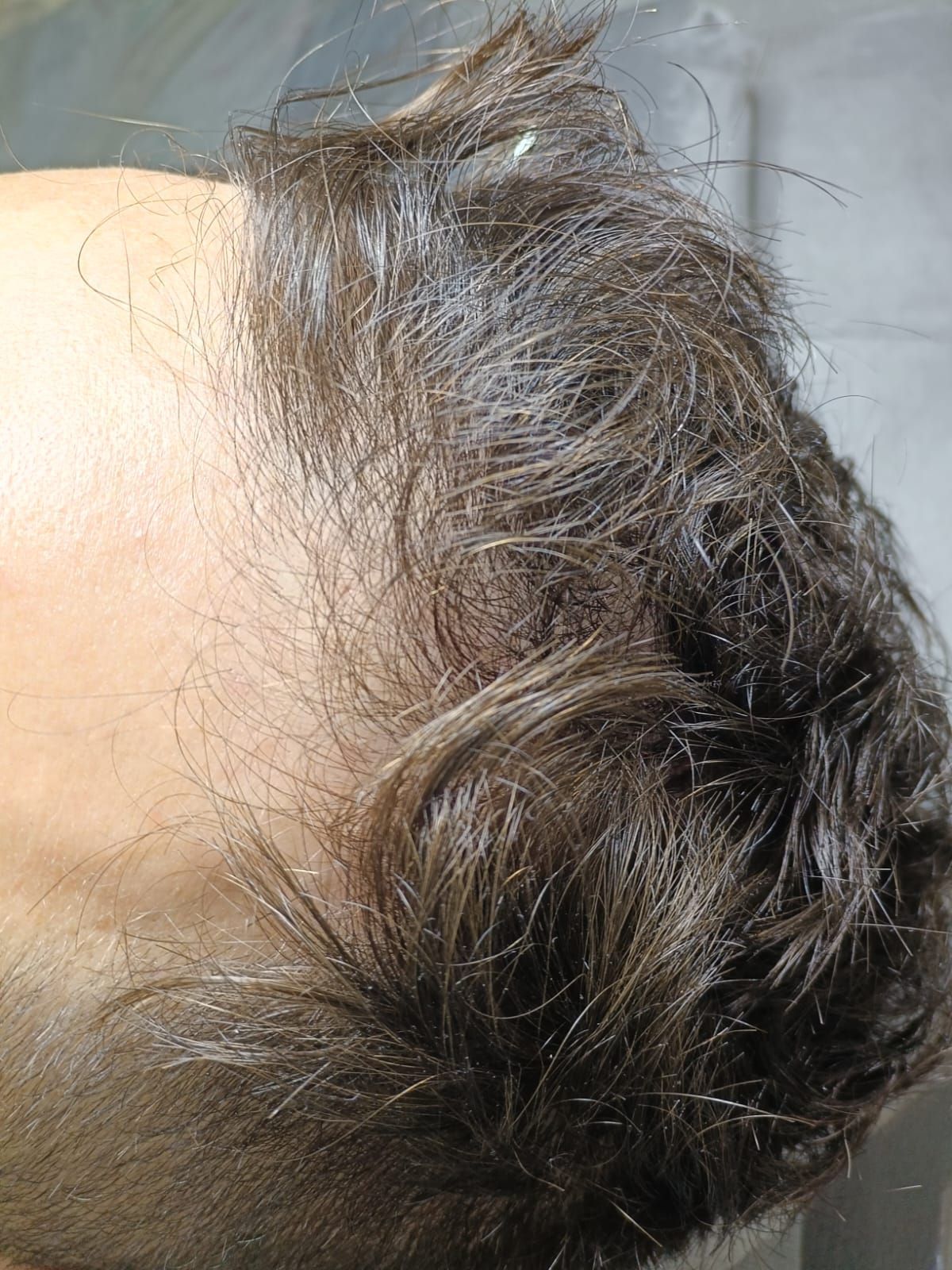 Fotos comparativas del rostro y cuello de una mujer antes y después de un procedimiento cosmético.