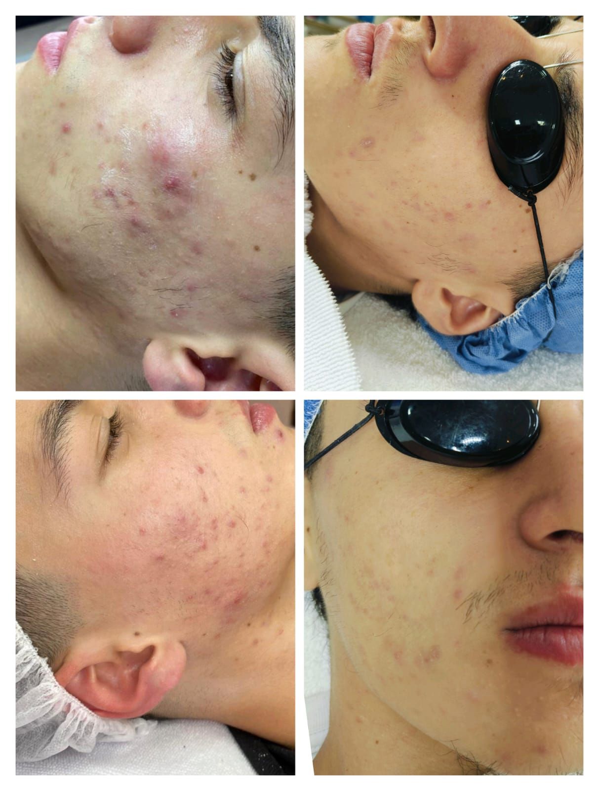 Evolución del tratamiento del acné. Piel facial con manchas rojas antes, durante y después de la terapia láser.