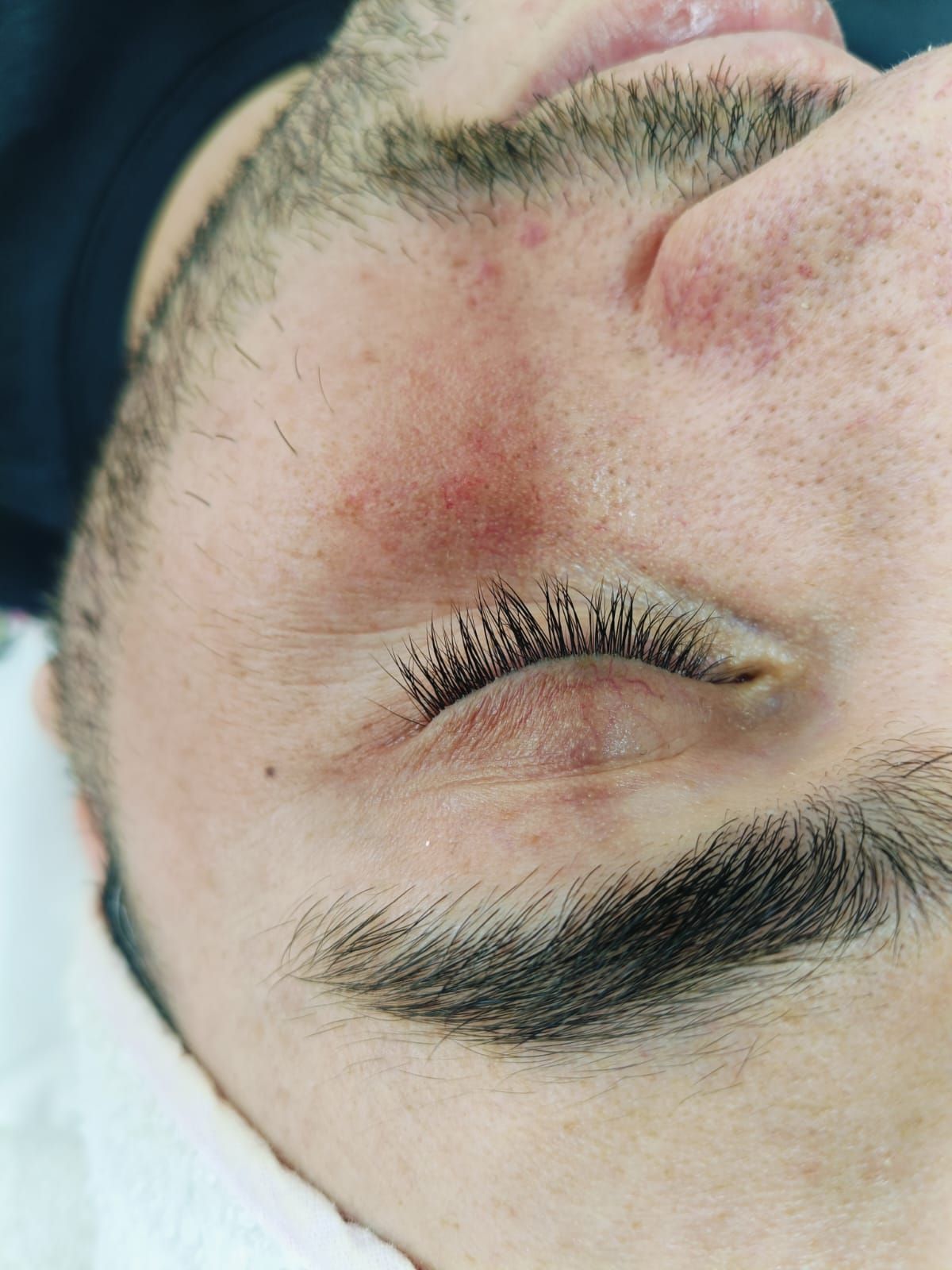 Comparación del rostro de una mujer antes y después del tratamiento.